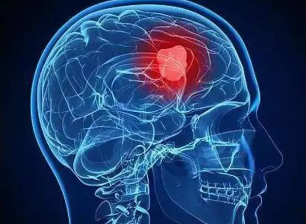 8种治疗脑胶质瘤的药物及疗法