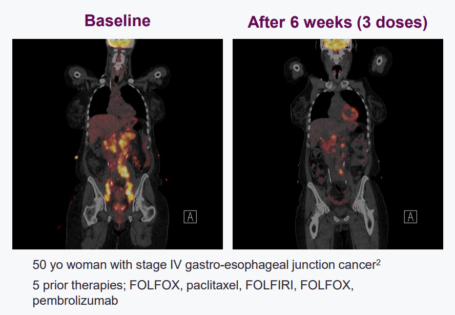 广谱抗癌药 Bema Bemarituzab 有望突破胃癌十年 药荒
