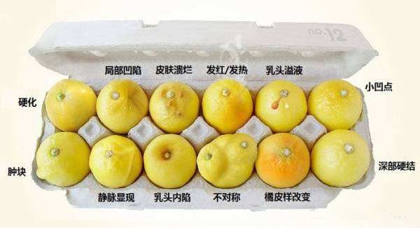 成年女性应该非常重视乳房肿块的触诊.