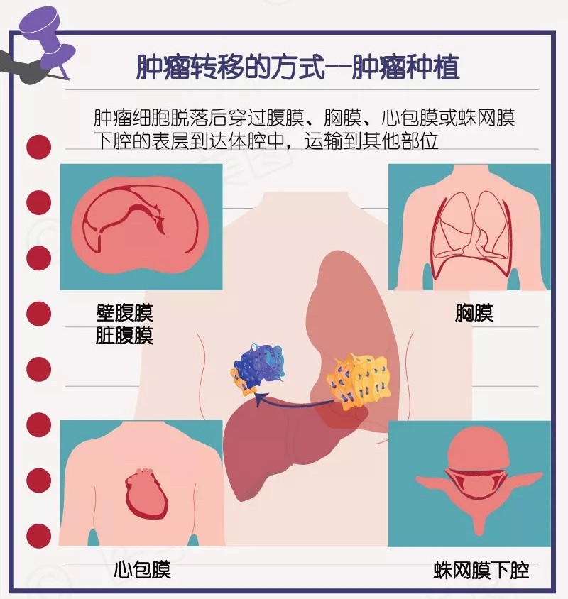 癌症最可怕的是转移那么癌症是如何转移容易转移至哪些部位