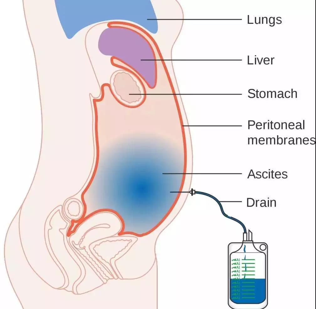 2,抗肿瘤治疗腹腔内化疗 热疗:一般给予1至2次后即可显效