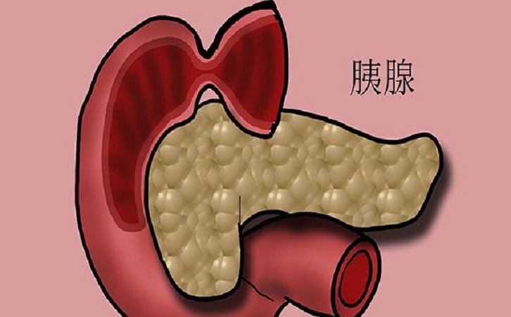 良性胰腺瘤能活十年吗?